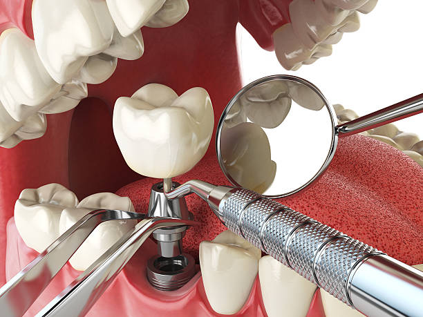 Best Emergency Tooth Extraction in Home Gardens, CA